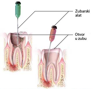 ENDODONCIJA 3