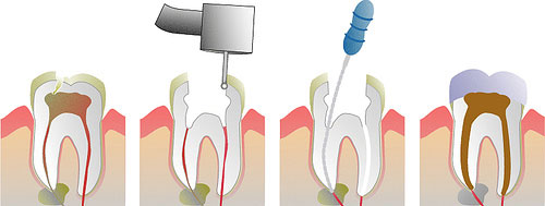 Endodoncija